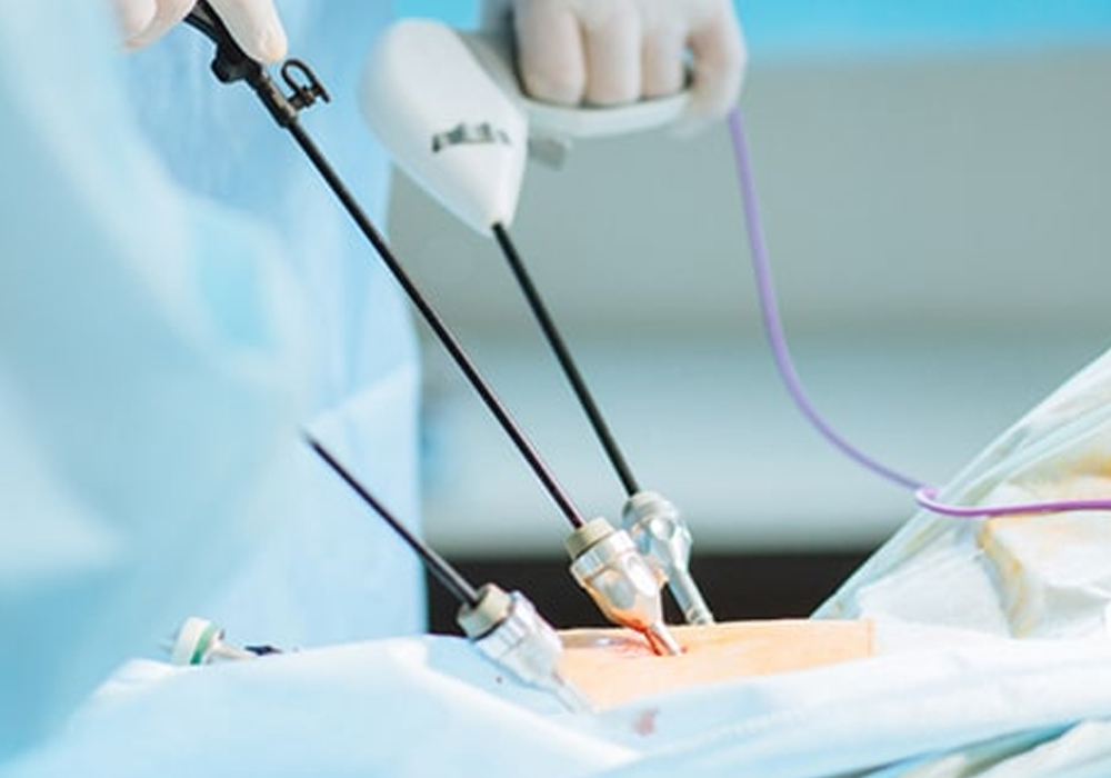 gallstone-surgery
