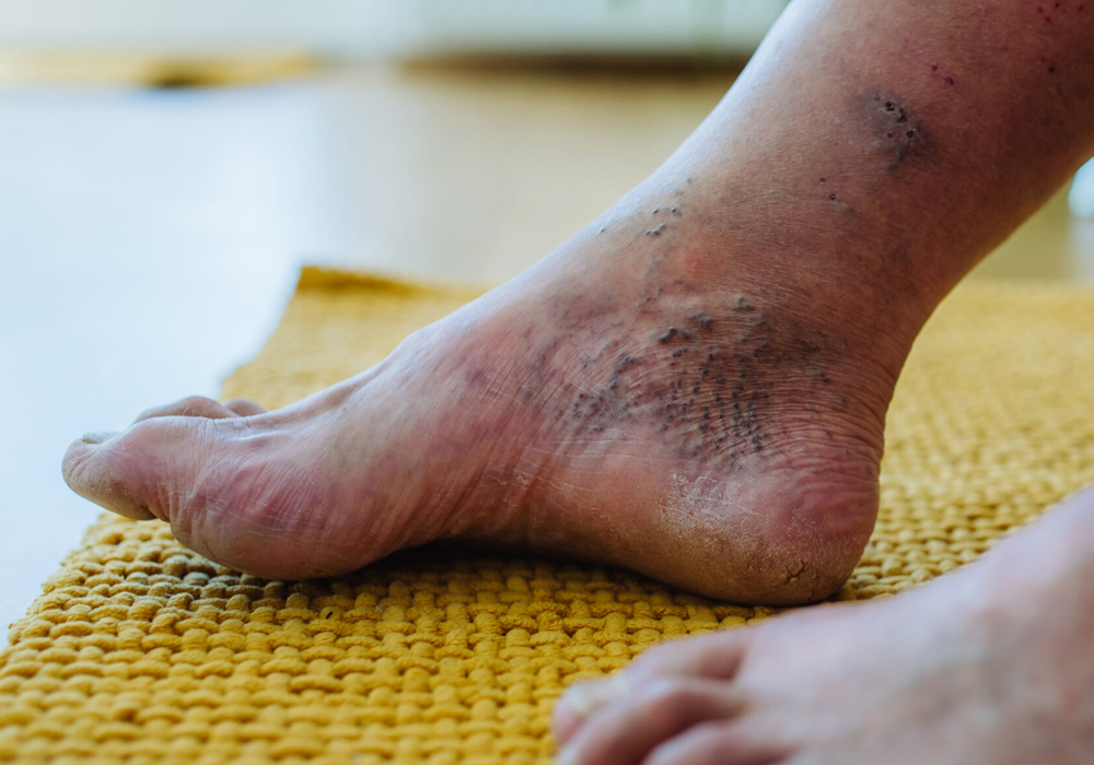 diabetic-foot